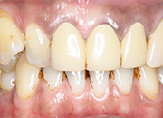 ガムピーリング