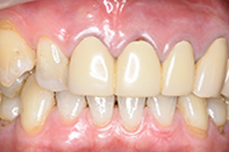 ガムピーリング