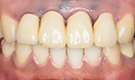 セラミック術前