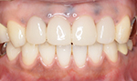 セラミック術前