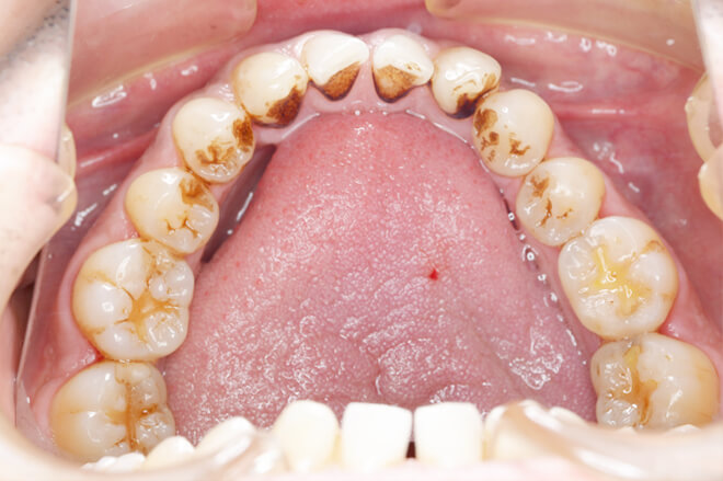 セラミック術前