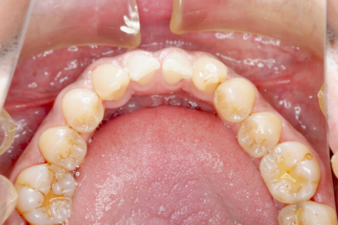 セラミック術後