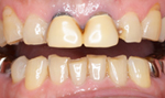 セラミック術前