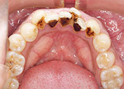 ホワイトニング