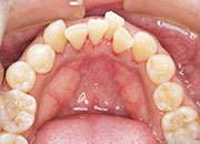 ホワイトニング