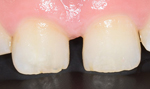 症例1(すきっ歯) セラミック術前