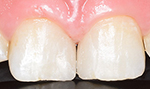 症例1(すきっ歯) セラミック術前