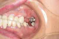 スマートデンチャー 術前