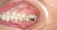 スマートデンチャー 術後