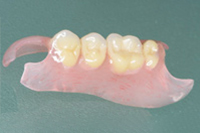 ノンクラスプデンチャー