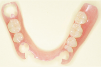 ノンクラスプデンチャー