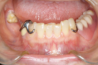 バネなし入れ歯 術前