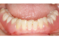 バネなし入れ歯 術後