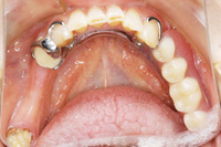バネなし入れ歯 術前