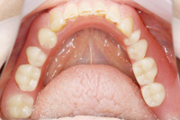 バネなし入れ歯 術後