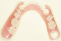 ノンクラスプデンチャー