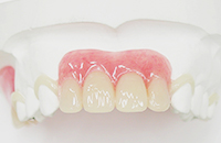 ノンクラスプデンチャーフレキシブルタイプ